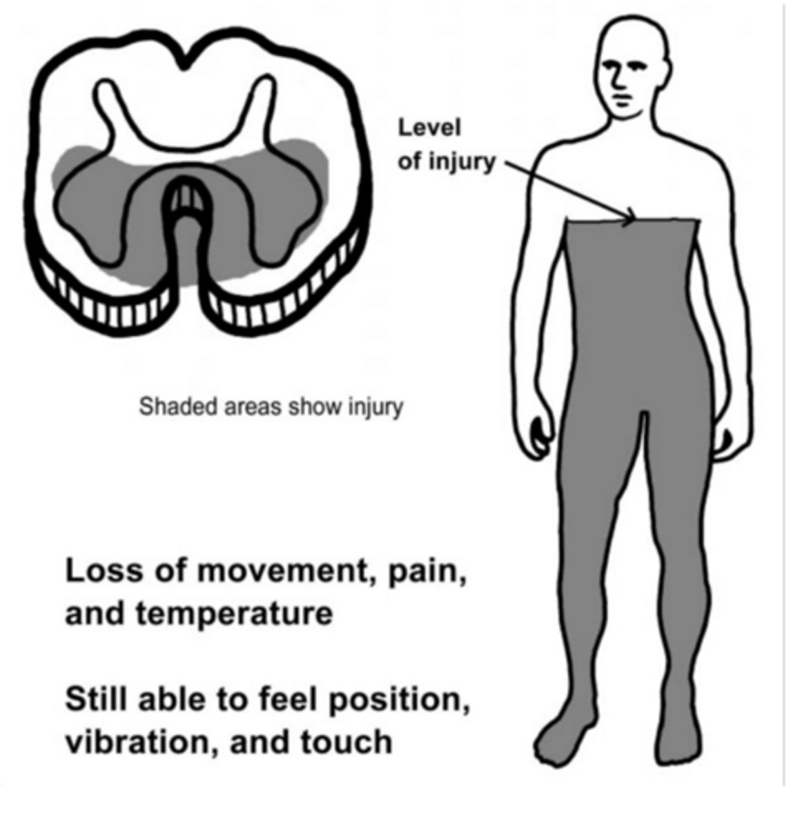 <p>hyperflexion injury</p><p>-loss of pain and temperture bilaterally </p><p>-loss of motor bilaterally </p>