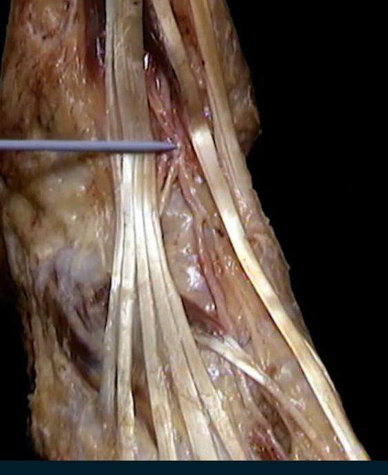 <p>Oppervlakkig(ma ook nie echt), Voetrug</p>