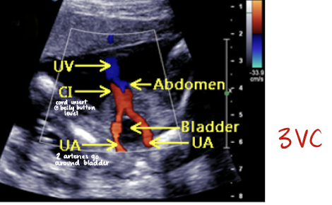 <ul><li><p>2 umbilical arteries carry <span style="color: red;">deoxygenated</span> blood from fetus to placenta</p><ul><li><p>umbilical arteries can be noted on either side of bladder at fetal insertion</p></li></ul></li></ul><p></p>