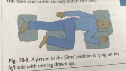 <p>A person in Sims’ position is lying on his left side with one leg drawn up</p>