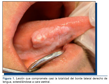 <p>Representa entre el 2% y 12% de las neoplasias epiteliales orales, más frecuente en la 6.ª y 7.ª década de vida y en hombres. Se presenta como una masa exofítica, verrugosa o papilomatosa de crecimiento lento, acompañada de disfagia/odinofagia.</p>