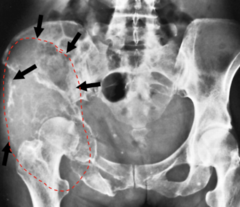 <p>What form of Mets is this?</p><p>- Bubbly, expansile lesion</p>