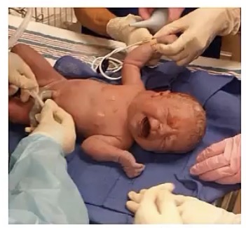 <p>-newborns; they’re congenital</p><p>-lymph drainage; lymph</p><p>-the neck</p><p>-prenatal US</p><p>-they’re associated with higher risk of aneuploidy and malformation, such as Down or Turner syndrome</p>
