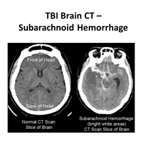 <p><mark data-color="yellow" style="background-color: yellow; color: inherit;">Subarachnoid hemorrhage</mark></p>