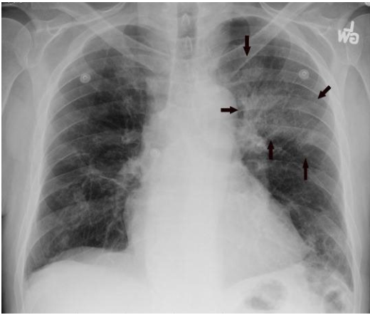 <p>What lobe is highlighted with arrows?</p>