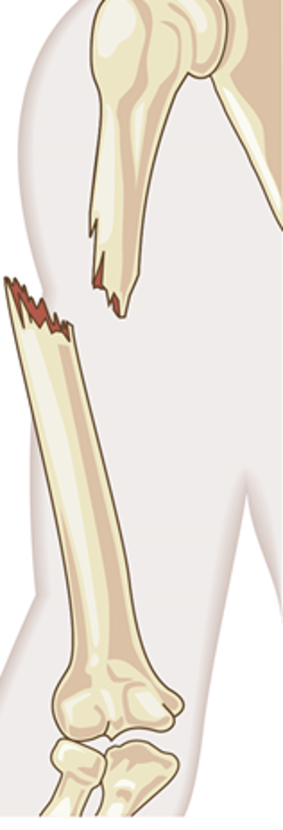 <p>a bone fracture in which the bone DOES penetrate the skin</p>