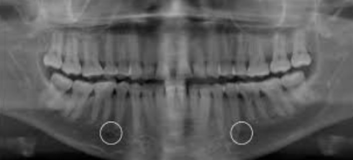 <p>Mental foramen</p>