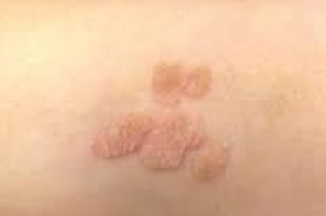 <p>Describe this lesion</p>