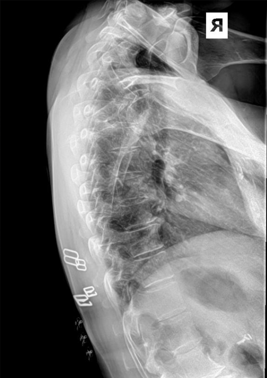 <p>Is this film of diagnostic quality (Lateral Thoracic)</p>