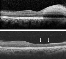 <ul><li><p>Acute thickening of the inner retina</p></li><li><p>Thinning of inner retina upon resolution</p></li></ul><p></p>
