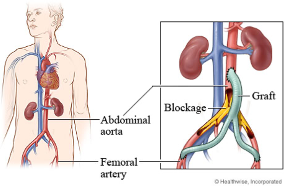 <p>aortic bypass grafts</p>