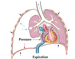 <p>This image shows a patient with tension pneumothorax. The air is trapped in</p>