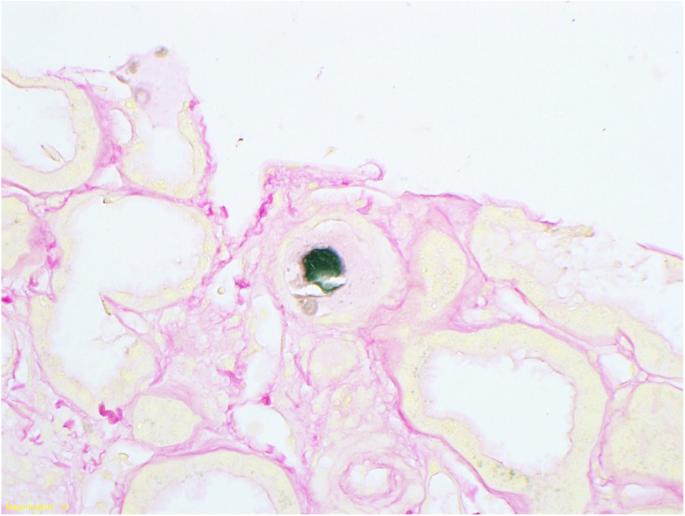 <p><em>El Chediak, A., Janom, K., &amp; Koubar, S. H. (2020). Bile casts visualized by Hall stain [Photomicrograph]. Renal Replacement Therapy, 6, Article 15.</em></p>