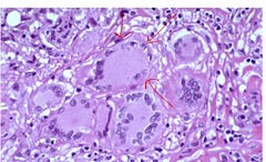 <p>multinucleated giant cells</p>