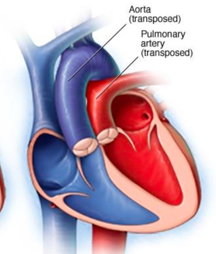 <p>the aorta and pulmonary artery connect to the <strong>wrong</strong> ventricles (they’re swapped)</p><ul><li><p>aorta = RV (deoxygenated blood goes to body)</p></li><li><p>pulmonary artery = LV (oxygenated blood goes to lungs again)</p></li></ul><p></p>