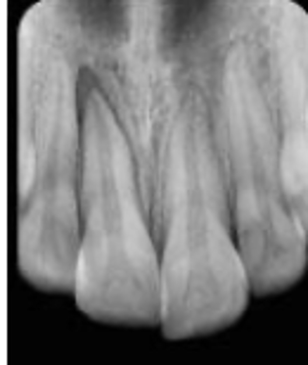 <p>Which trauma:</p><ul><li><p>Tooth displaced in palatal/lingual or labial direction</p></li><li><p>Nonmobile</p></li><li><p>Sensibility test -</p></li></ul><p></p>
