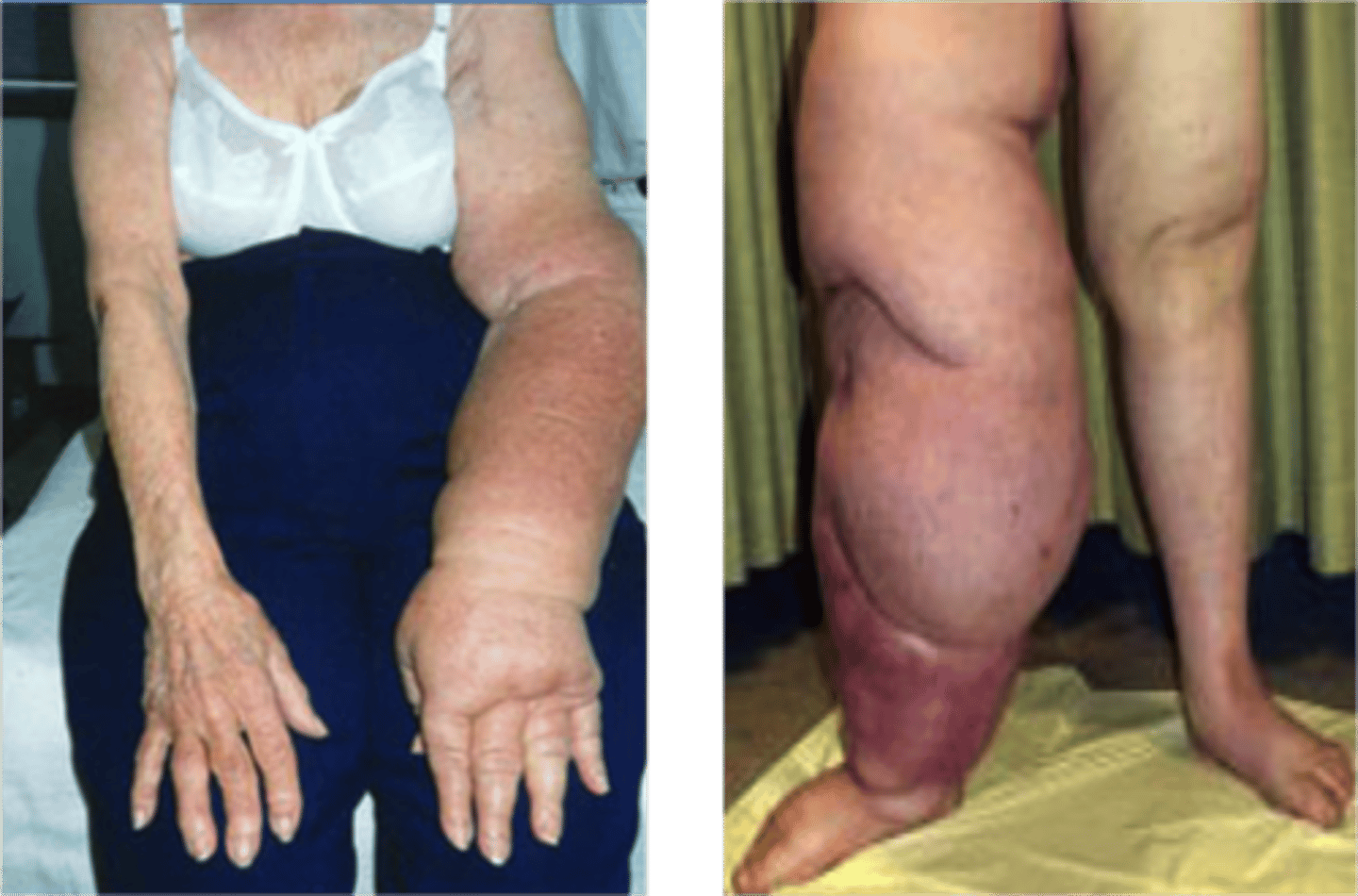 <p>enlarged lymph nodes, hard edema</p>