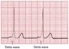 <p>delta wave and shortened PR interval</p><p></p>
