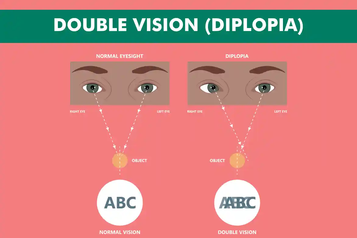<p>double vision </p>