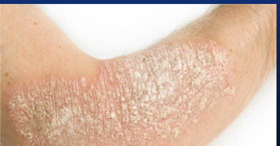 <p>Usually associated with oral infections.</p>