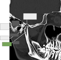 <p>TMJ: This is the</p>