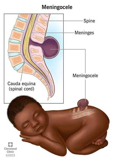 <p><strong>meninges herniate through a vertebral defect</strong>, forming a visible spinal sac that’s usually covered with skin</p><ul><li><p>usually surgically corrected, but not asap</p></li></ul><p></p>