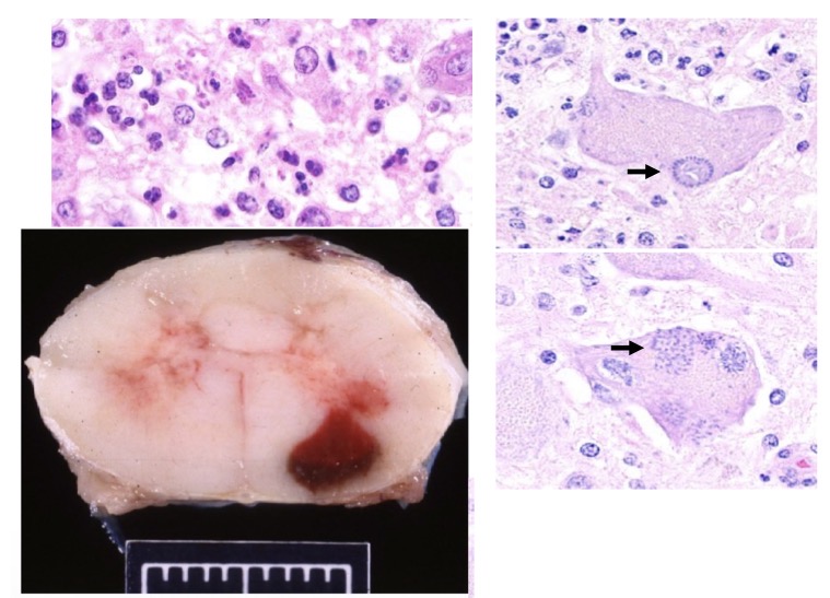 <p>What is this lesion?</p>