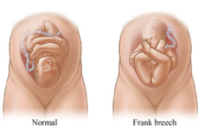 <p>the baby's position in the uterus causes the buttocks to be the first part to emerge</p>