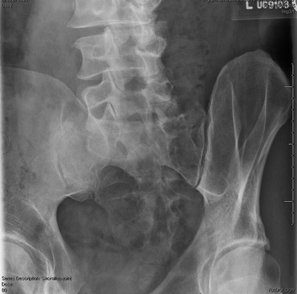 <p>critique this Oblique SI joints</p>