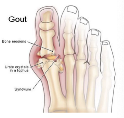 <ul><li><p>metabolic disorder characterized by elevated uric acid levels in blood resulting in deposistion of irate crystals in synovial fluid and joint tissues </p></li><li><p>high serum: > 8.5mg/dL Uric Acid</p></li><li><p>mostly seen in males, particularly AA</p></li></ul><p></p>