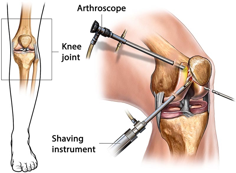 <p><span style="background-color: rgba(0, 0, 0, 0);"><strong>Arthroscopy</strong></span></p>