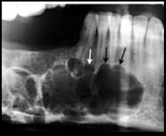 <p>A radiolucent lesion that appears to extend up the periodontal ligament and between the roots.</p>