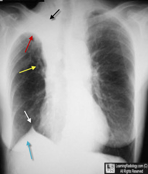 <p>Frontal view: reverse S sign of Golden when underlying obstructive mass. Juxtaphrenic peak sign is a peridiaphragmatic trangular opacity caused by diaphragmatic traction from an inferior accessory fissure og an inferior pulmonary ligament, this is in RUL volume loss from any cause.<br>Lateral view: Wedge-shaped collapse of RUL.</p>