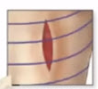 <p>Incisions made _____ cleavage lines gape, higher infection rate and therefore take longer to heal with less scar formation.</p>
