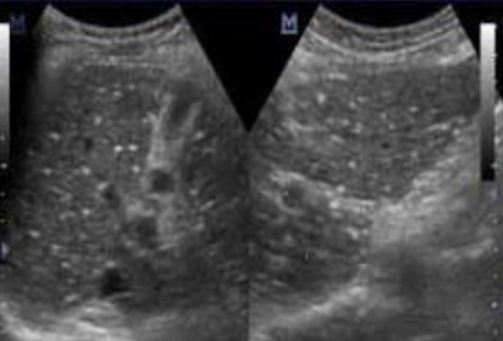 <p>which type of hepatitis is this showing (acute/chronic)</p>