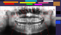 <p>ID the hard tissue anatomy indicated by the arrow pointing from the light blue box:</p>