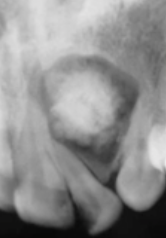 <p>which of the following is NOT in the differential: </p><p>odontoma</p><p>cemento-osseous dysplsia </p><p>calcifying epithelial odontogenic tumor </p><p>calcifying ododtogenic cyst</p>