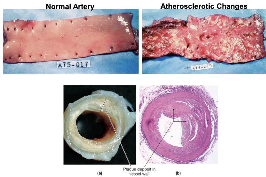 <ul><li><p>veins:</p><ul><li><p>Patchy thickenings – narrowing in those regions</p></li><li><p>Weakening of connective tissue in walls – varicose veins, hemorrhoids</p></li></ul></li><li><p>Arteries</p><ul><li><p>Less elastic</p></li><li><p>Deposits of fatty substances, calcium, connective tissue</p></li></ul></li><li><p>Arteriosclerosis</p><ul><li><p>Arteries become less elastic</p></li><li><p>Risk of increased BP</p></li></ul></li><li><p>Atherosclerosis</p><ul><li><p>Deposition of material in walls – fatlike substance, connective tissue, calcium salts</p></li><li><p>Artery narrows – impairs blood flow</p></li></ul></li></ul><p></p>