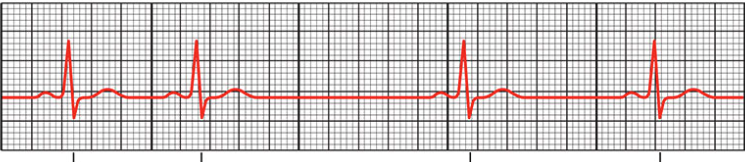 <p>longer T-P interval</p>