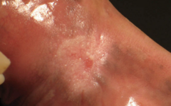 <p>Chronic Candida-associated white plaque.</p>