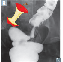 <p>Apple core lesion </p>