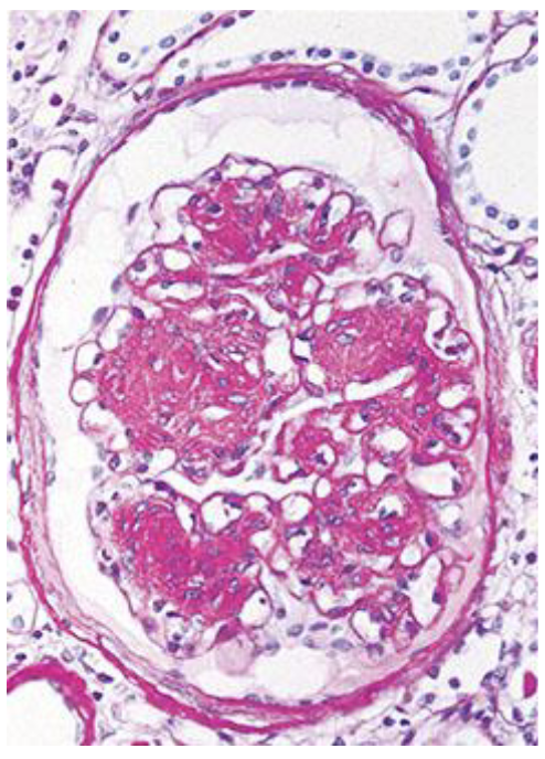 <p>A 50-year-old man with hypertension and nephrotic syndrome undergoes a renal biopsy. The appearance of the biopsy is similar to that shown in the figure. Of the following possible additional laboratory findings, which one is most characteristically associated with this lesion?</p>