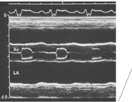 <ul><li><p>EPSS >6 MM</p></li></ul><p>• B-BUMP</p><p>• DECREASED AORTIC ROOT MOTION AND EARLY AVC (b/c of decreased CO)</p>