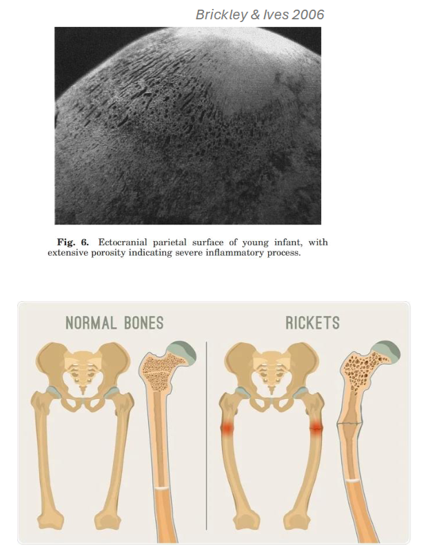 <p>Pathology: Metabolic Diseases Example: Vitamin deficiencies</p>