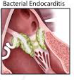 <p>Used for:</p><ul><li><p>Complicated skin infections</p></li><li><p>MRSA bacteremia</p></li><li><p>Right-sided infective endocarditis(a rare but life-threatening inflammation of the heart’s inner lining and valves, usually caused by bacterial or fungal infections)</p></li></ul><p></p>