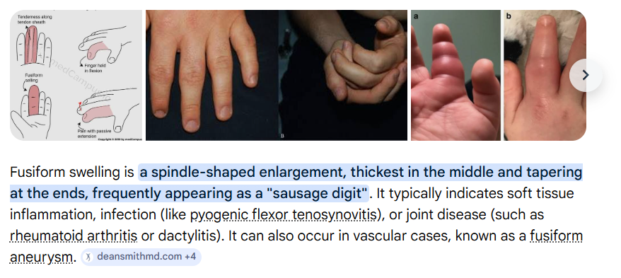 <p>c. Ewing’s sarcoma </p>