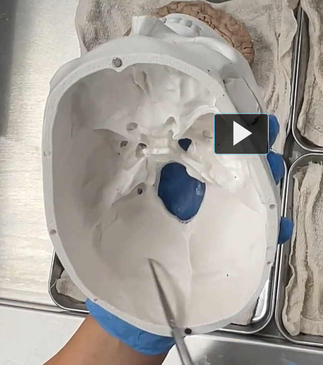 <p>The cerebellum sits in a region called the <strong>posterior cranial fossa</strong></p><p>The posterior cranial fossa is the <strong>deepest and most posterior depression on the floor of the skull</strong>. It houses the <strong>cerebellum, pons, and medulla oblongata</strong>. It is the part of the cranial cavity behind the petrous temporal bones and around the foramen magnum.</p><ul><li><p><strong>Posterior</strong>: <strong>behind</strong></p></li><li><p><strong>Cranial</strong>: <strong>skull</strong></p></li><li><p><strong>Fossa</strong>: <strong>ditch</strong></p></li></ul><p></p>