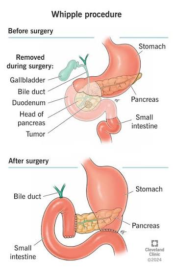 <p>Whipple (pancreaticoduodenectomy)</p>