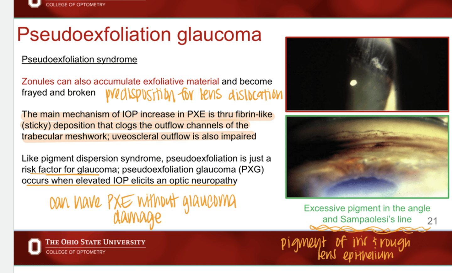 <p>True or False: </p><p>Like PDS, PXE is just a risk factor for glacoma</p>