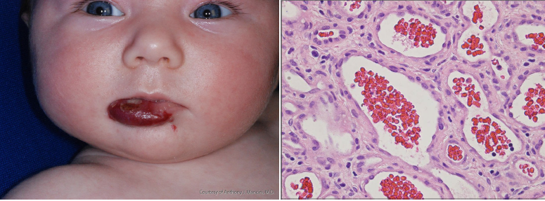 <ul><li><p>most common soft tissue tumors of infancy</p></li><li><p>prevalence of 1-2% in neonates and 12% by the age of 1 year</p></li><li><p>rapid postnatal growth for 8-12 months, followed by slow regression for the next 1-5 years</p></li><li><p>head and neck as most common location</p></li><li><p>capillary, cavernous, and juvenile as subtypes </p></li></ul><p></p>